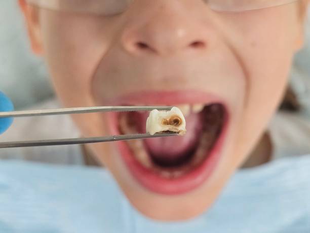 Best Emergency Dental Care for Broken or Chipped Teeth in Rock Creek, AL