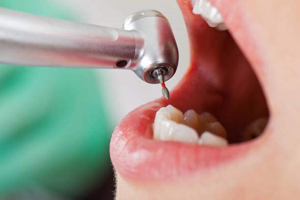 Best Emergency Treatment for Dental Infections or Abscesses in Rock Creek, AL